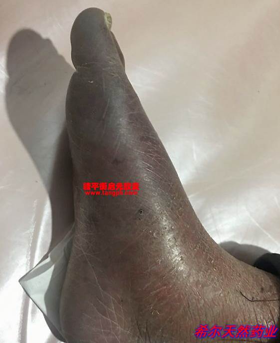 糖尿病人的脚颜色发黑发暗是什么原因