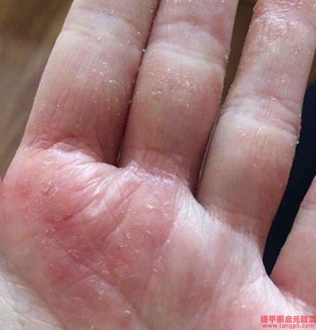 皮肤科医生:糖尿病?癣先知。为了一家人